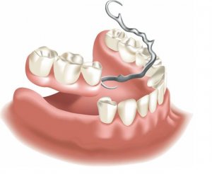 Стоматологический центр «Эксперт» - это недорогое протезирование зубов