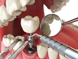 Быстро восстановить зубы к концу года поможет экспресс-имплантация