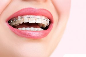 В стоматологической клинике Зууб.рф на установку брекетов действует скидка до 50%