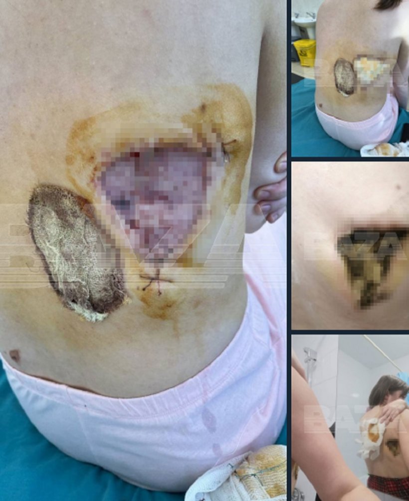 У жительницы Тюмени сгорела спина во время операции – из-за анестезии боль не чувствовалась. Девушка отсудила 350 тысяч у больницы