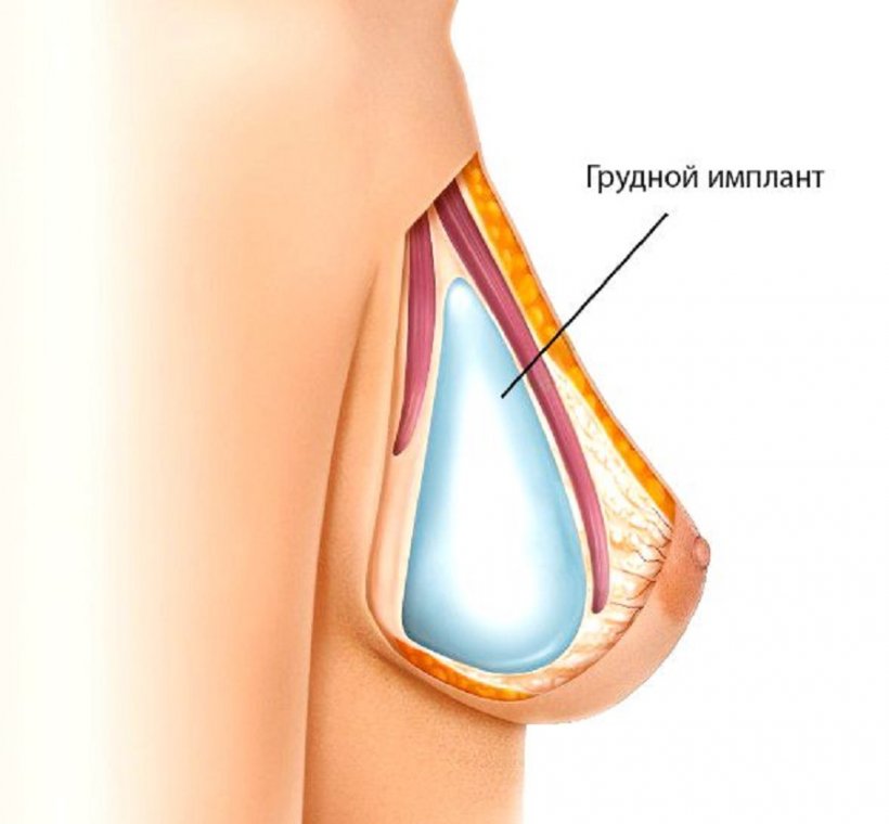 Как выбрать оптимальный объем импланта для увеличения груди