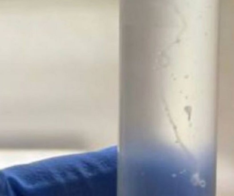 Червяка в глазу нашли у жительницы Омска — паразит мог оказаться под веком после укуса комара