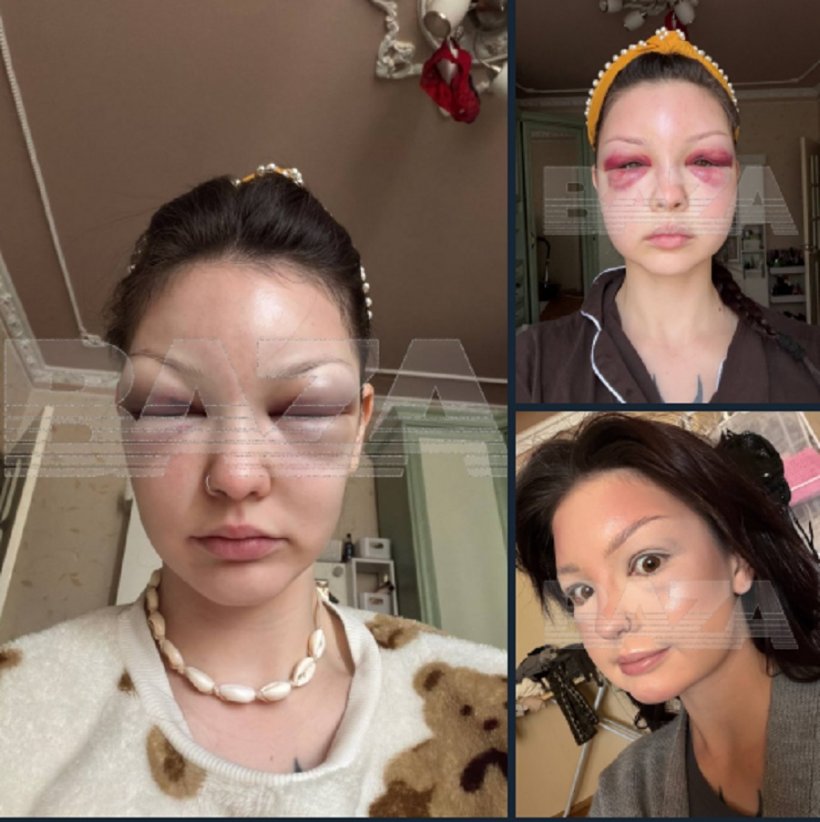 Москвичка хотела убрать синяки, но получила распухшие до невероятных размеров глаза